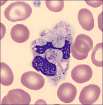 cito_tuiter's tweet photo. Patient with false thrombocytopenia. 

Etiology?. 🔬🤔
#hematology #citologia #MedTwitter #hemepath #fridaynight  #cito https://t.co/PwyCOKe36H