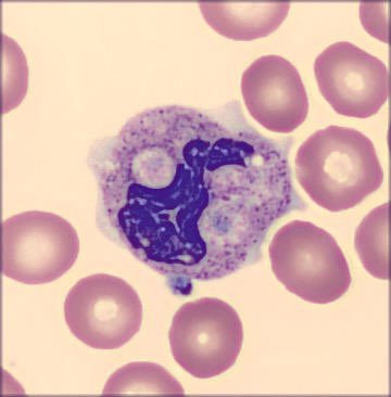cito_tuiter's tweet photo. Patient with false thrombocytopenia. 

Etiology?. 🔬🤔
#hematology #citologia #MedTwitter #hemepath #fridaynight  #cito https://t.co/PwyCOKe36H