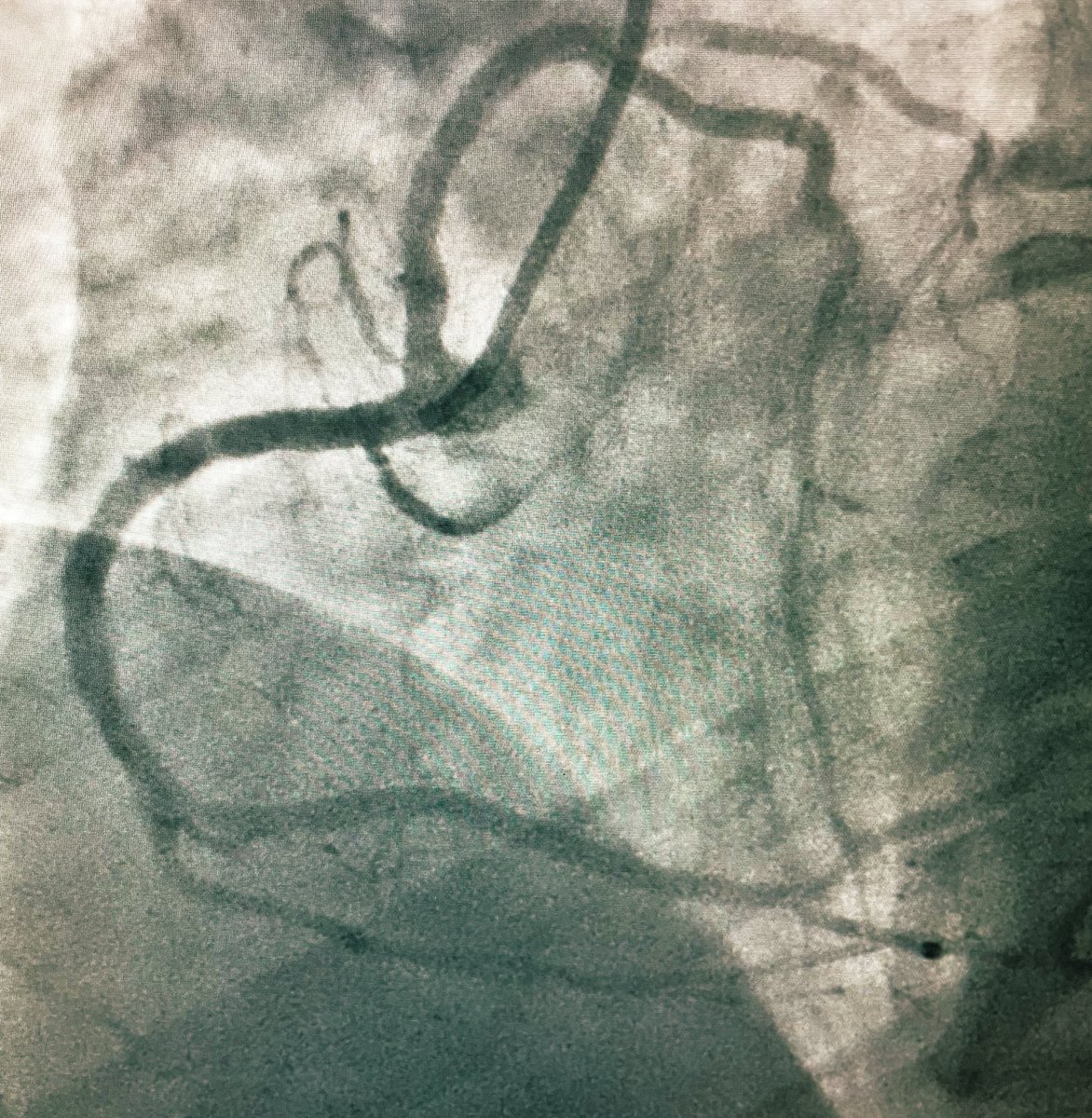 Wishing all my cardiology friends a Happy #WorldHeartDay2023 with this lovely heart within a heart created by anomalous origin of the circumflex artery🫀
#RadialFirst