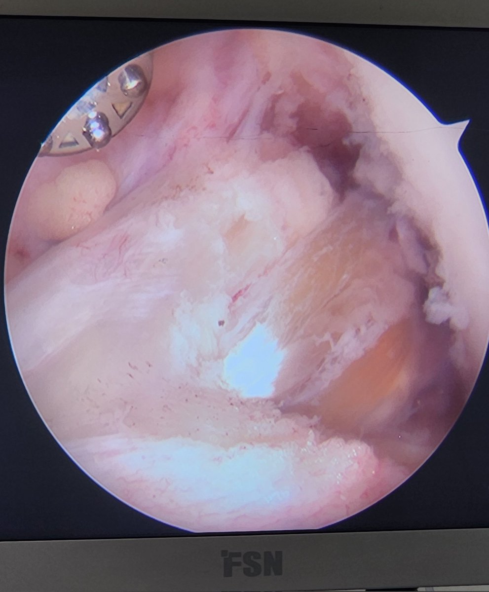 I love my job 🫰🏻✨️
ACL double bundle semiT augmentation
#aclsurgery #aclreconstruction #arthroscopicsurgery