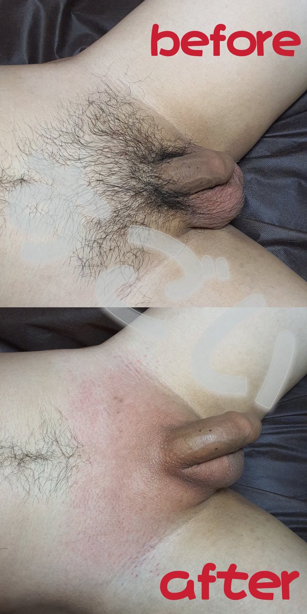 客人子軒是一名職軍，在軍中環境很悶熱很癢，難得放假，說要回家給女朋友一個驚喜，於是選擇巴西式全除~因為有肚毛，於是我幫他修一個型，除完後，武器看起來有更大了呢！女朋友真幸福!!
立馬預約:lin.ee/J2faxaD