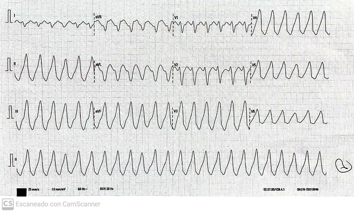 💪🏽CASO CLÍNICO 🥸 80años con miocardiopatía isquémica multivaso💔 que acude por molestias torácicas 🏥 🤔💭 TSV o TV? 🧐Cómo crees que debe ser su función ventricular?👀 Qué pistas nos da el ECG? 🕵🏻‍♀️