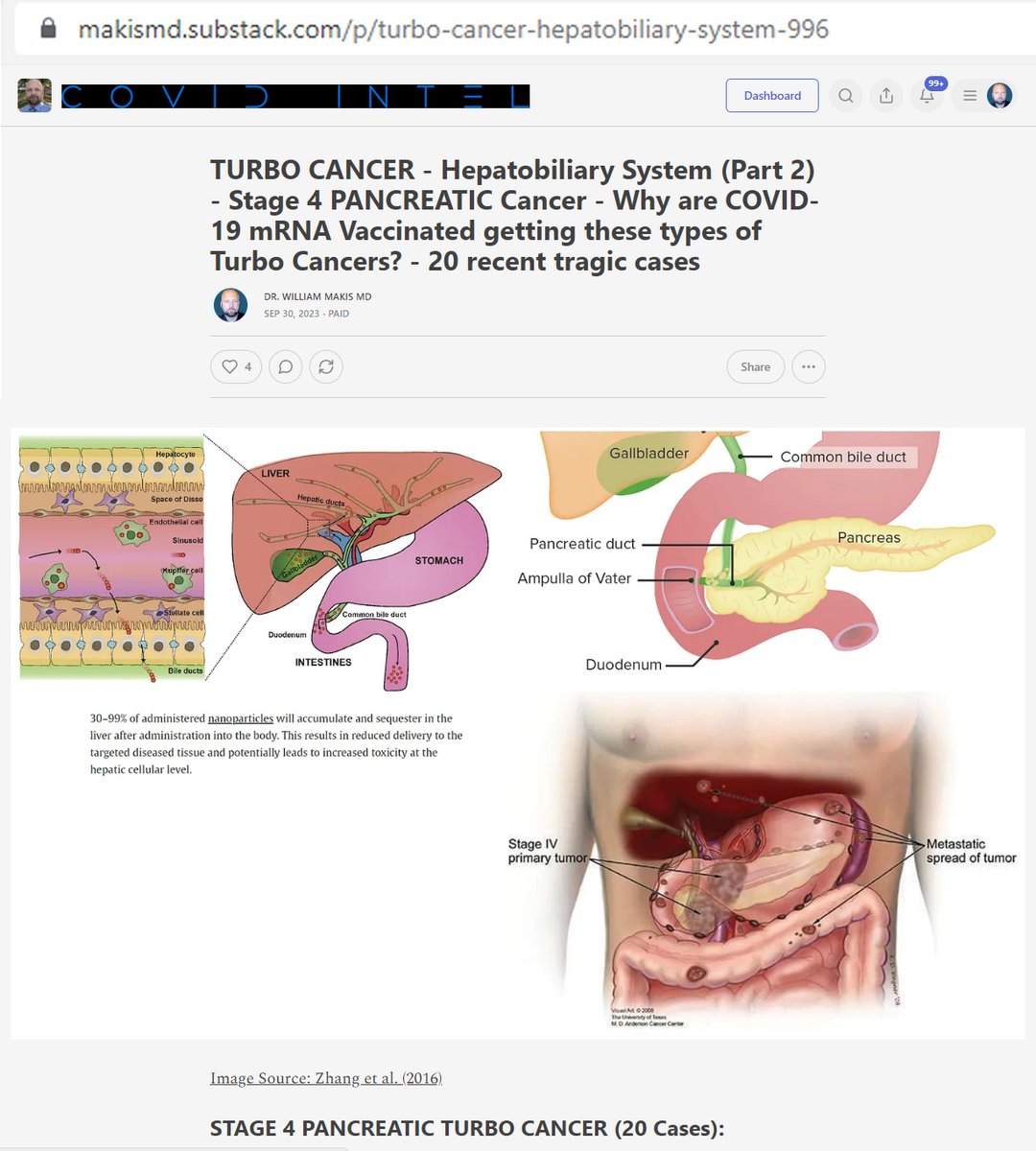 NEW ARTICLE: TURBO CANCER - Stage 4 PANCREATIC CANCER - Why are COVID-19 mRNA Vaccinated getting these types of Cancers? 

There is a Tsunami of Stage 4 Pancreatic Cancers being diagnosed RIGHT NOW in mRNA Vaccinated people in their 30s, 40s, 50s:

Sep.21, 2023 - Cedar Rapids, IA