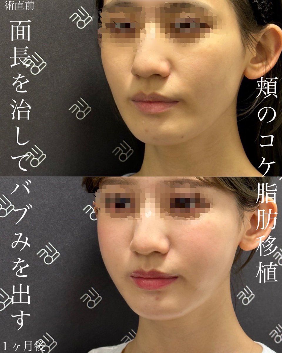 tenyuru's tweet photo. 今日はカウンセリングルームで
お客様が号泣されてました

問診票を確認すると
「脂肪吸引で頬がこけてしまった」
「脂肪移植で修正したい」

最近本当に多すぎます...

原因は圧倒的に適応がないのに⚠️
✅バッカル除去
✅ジョールファット除去
✅頬の脂肪吸引

これをしたパターンがほとんどです

特に新しめの大手小顔クリニックの
新人医師で施術している
パターンが多いです

脂肪吸引は本当に適応ないと
顔がホラーマンになるので注意...⚠️