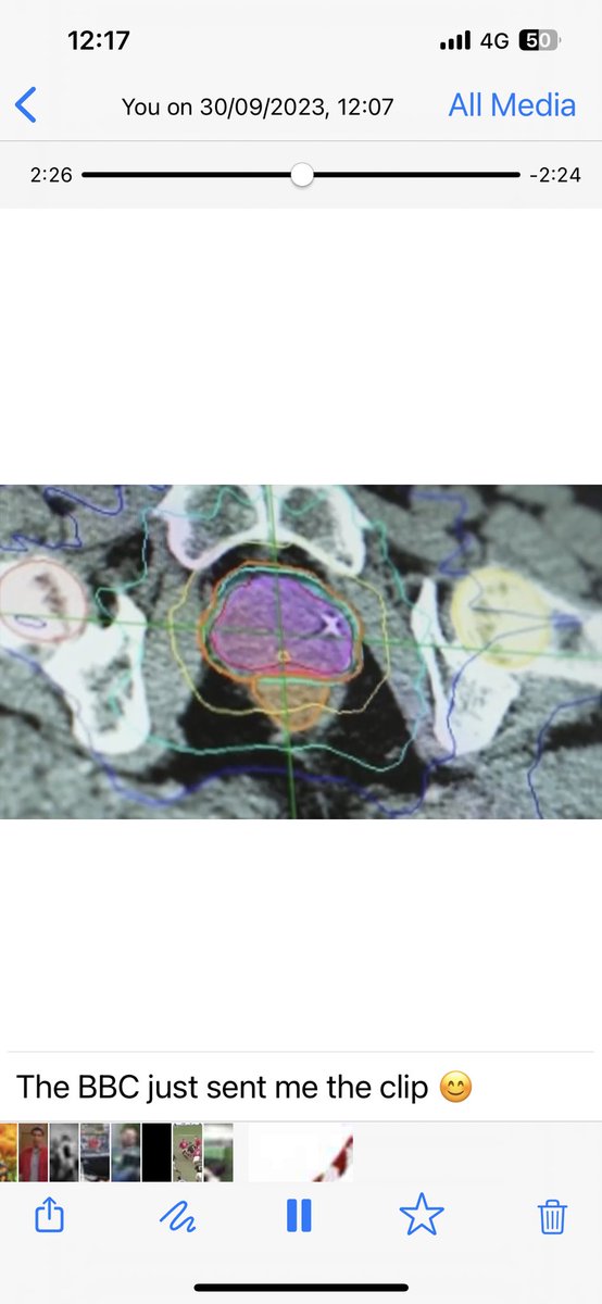 nickva1's tweet photo. Gratified and humbled by the media response to #PACE B, fantastic team effort! Looking forward to presenting the results at #ASTRO23 ⁦@EmmaHall71⁩ ⁦@alison_tree⁩ ⁦@royalmarsdenNHS⁩ https://t.co/7PAud13KSL
