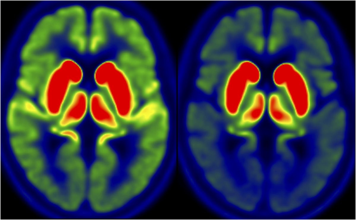 Brain (@brain1878) on Twitter photo Okkels et al. provide evidence for severe cholinergic terminal loss in newly diagnosed dementia with Lewy bodies, and suggest that degeneration of the cholinergic system leads to altered brain metabolism. tinyurl.com/2b65nrxs
+commentary: tinyurl.com/3s4zfbsb Okkels et al. provide evidence for severe cholinergic terminal loss in newly diagnosed dementia with Lewy bodies, and suggest that degeneration of the cholinergic system leads to altered brain metabolism. tinyurl.com/2b65nrxs
+commentary: tinyurl.com/3s4zfbsb