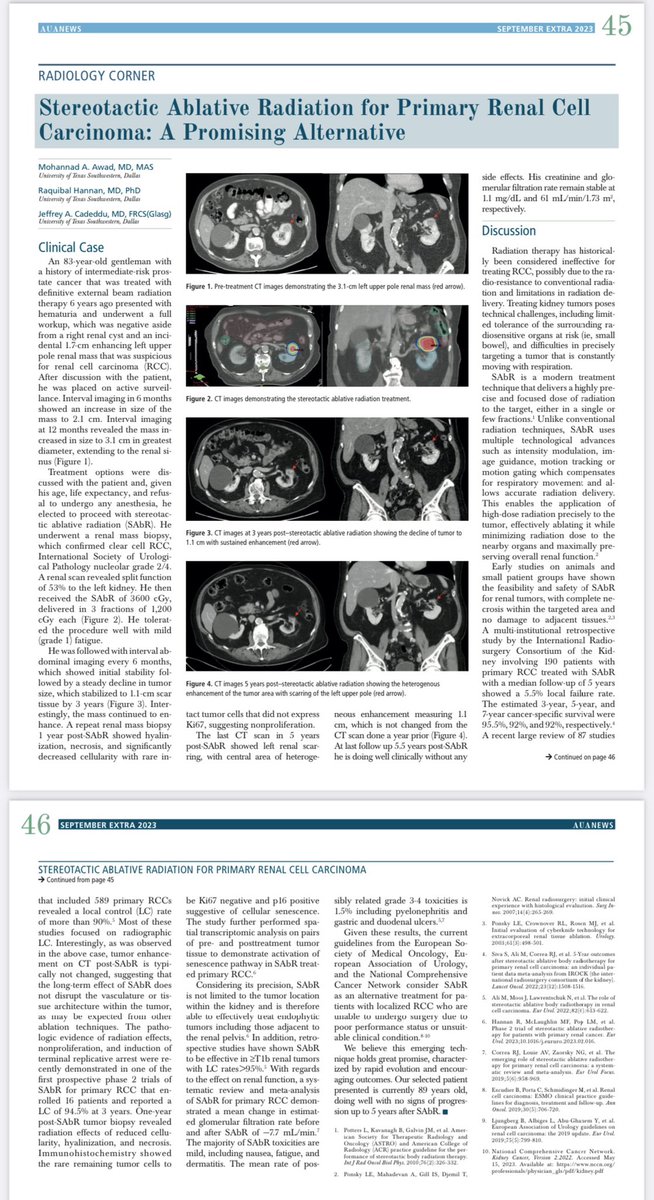 Mohannad Awad (@mohannadawad) on Twitter photo Stereotactic Ablative Radiation for primary RCC is promising. Our article at #AUANews <a href="/Raquib_Hannan/">Raquibul Hannan</a> <a href="/jeffcadeddu/">Jeff Cadeddu</a> <a href="/AmerUrological/">Amer. Urol. Assn.</a> Stereotactic Ablative Radiation for primary RCC is promising. Our article at #AUANews <a href="/Raquib_Hannan/">Raquibul Hannan</a> <a href="/jeffcadeddu/">Jeff Cadeddu</a> <a href="/AmerUrological/">Amer. Urol. Assn.</a>
