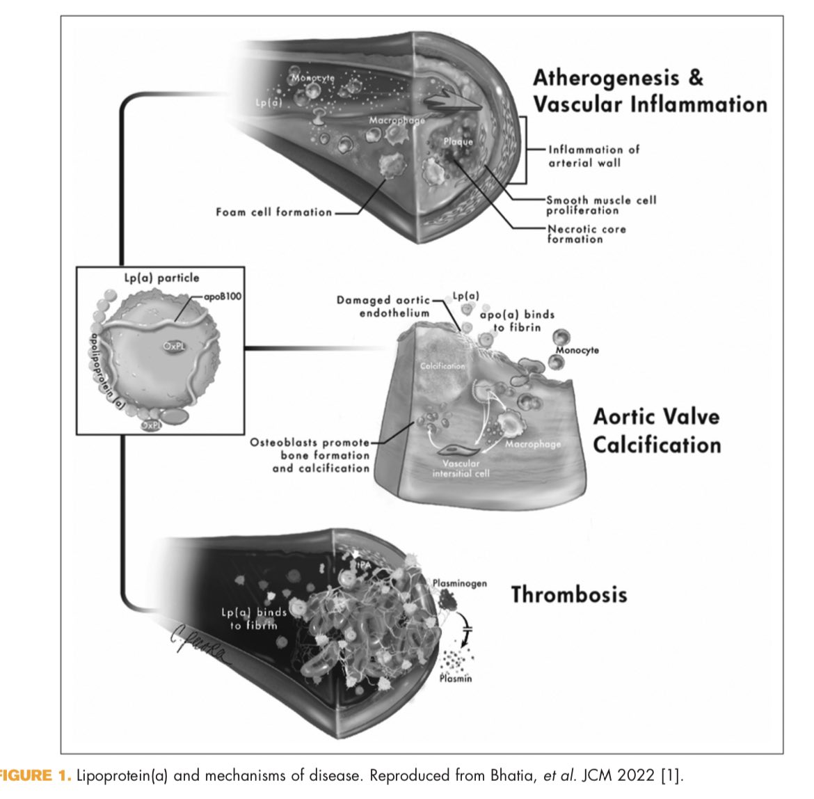 drpablocorral's tweet photo. 👉Aspirin and lipoprotein(a) in primary prevention

👏Another great review about this hot topic 

☝️Must read 

https://t.co/wAYvB8yDwK https://t.co/v9gVyxaPhP