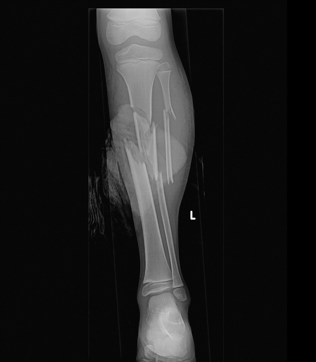 orthoEMpearls's tweet photo. 7yo struck by a motor vehicle presents to your rural ED. How do you manage this injury in the ED? @TheSGEM #FOAMed #EmergencyMedicine 

courtesy of Shailaja Muniraj, https://t.co/AsKCiiA6RJ, rID: 49420 https://t.co/2NOCqPVvRG