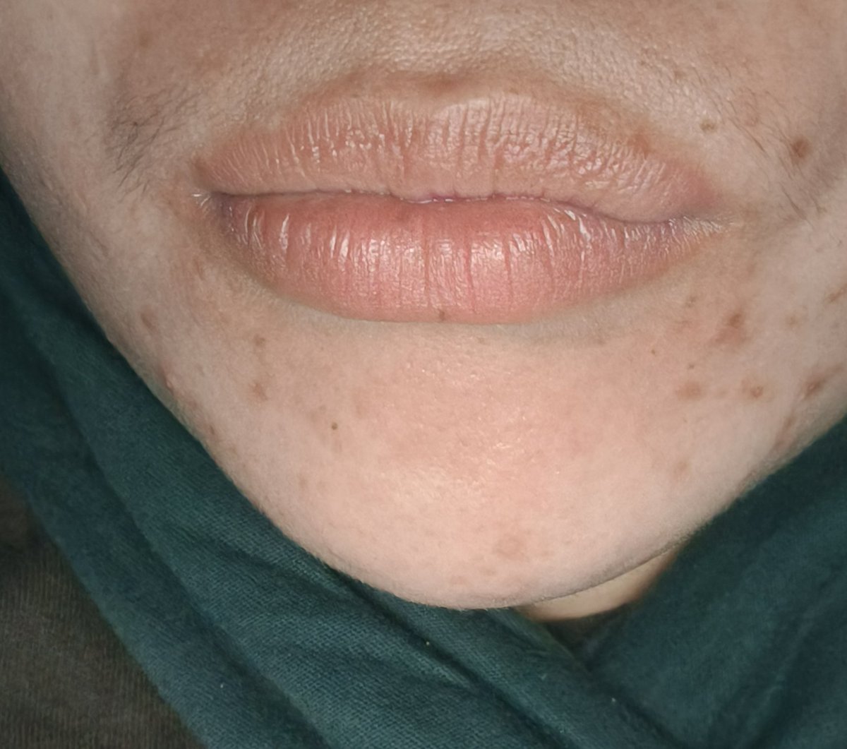 simplerock19's tweet photo. Pimples.. minahal mo talaga ako ng subra.... Ang hirap tanggalin ng marks mo... https://t.co/wJlrzqY1o4