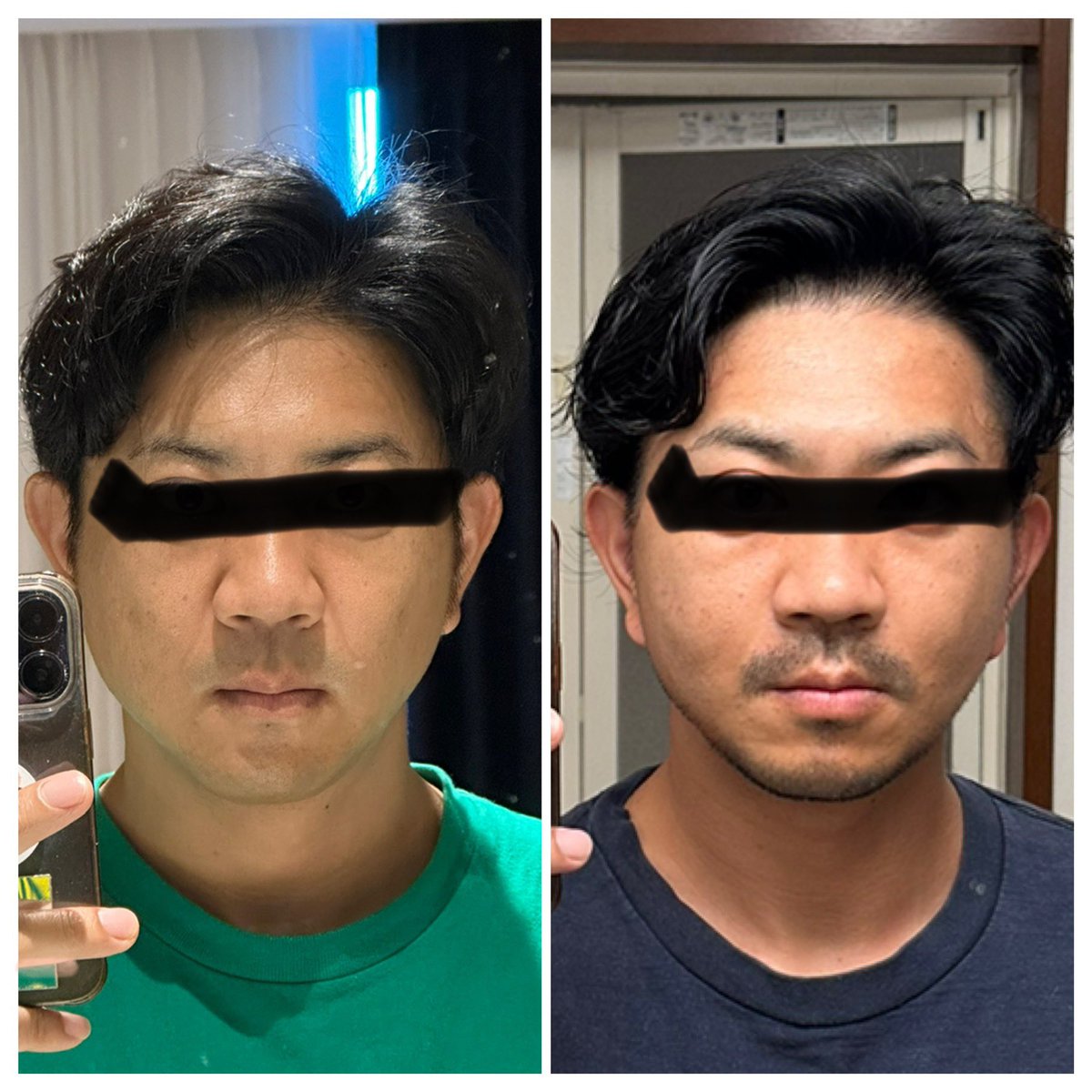 切開リフトからほぼ1ヶ月経過

頬の感覚は奥の方は戻らず、硬い
耳の感覚はだいぶ戻ってきました

比較すると、なぜか小顔になった？笑

明後日もインディバ行きます

#rex 
#切開リフト 
#バッカルファット 
#メーラーファット
#整形垢 
#韓国 
#整形
#ANA
#voco
#ダウンタイム
#メンズ美容