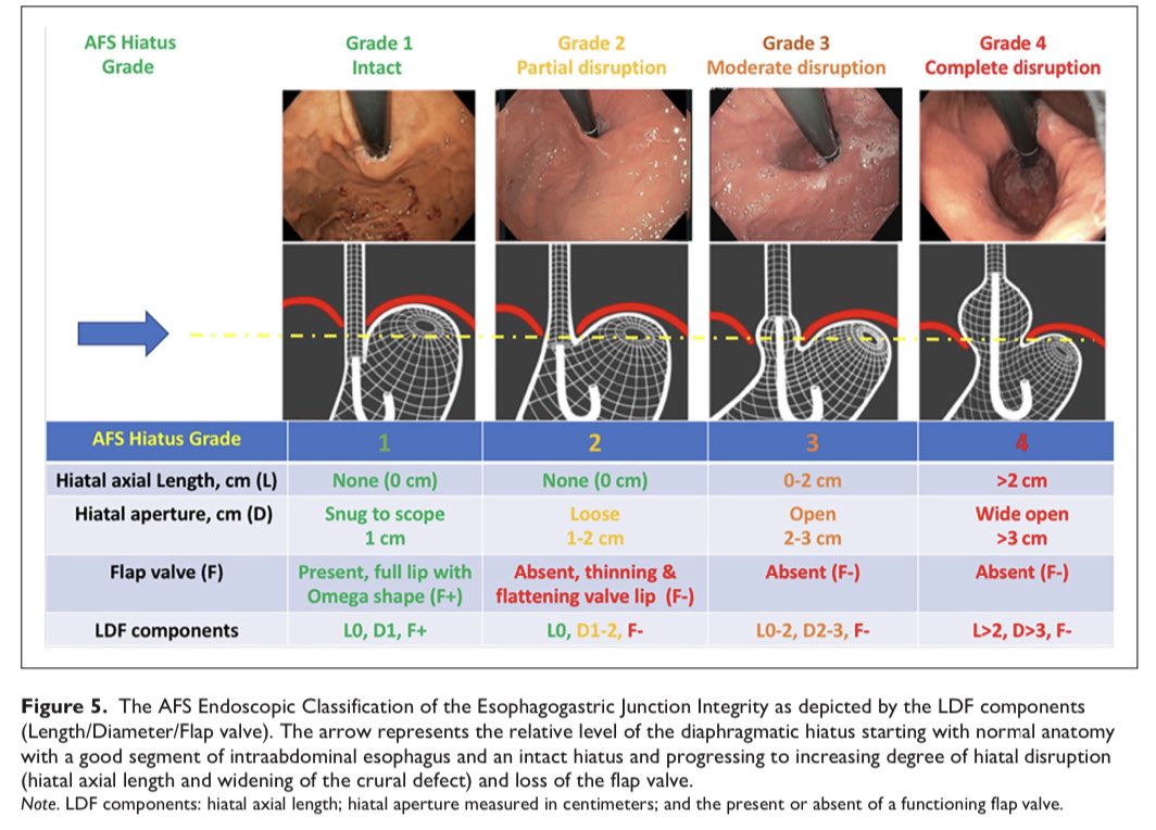foregut_journal's tweet photo. ‼️The AFS Classification of EGJ Integrity correlates with AET and DeMeester score - data presented at #AFS2023 by #Foregut authors
🔓Open access: https://t.co/B77VylsyCc
#GITwitter #SurgTwitter #EsophagealTwitter #EsoCrew #GERD #BetterTogether https://t.co/pKUkoBeDsd