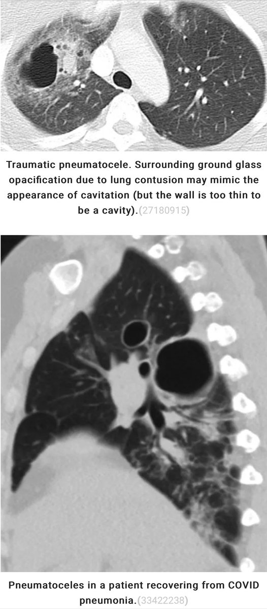 fresh chapter: cystic lung diseases!

⚽️ consider cystic dz in patients with spontaneous pneumothorax (eg lymphangioleiomyomatosis)

⚽️ pneumatoceles are often caused by trauma or infection. they’re scary-looking but usually resolve over time

emcrit.org/ibcc/cystic/#t…
