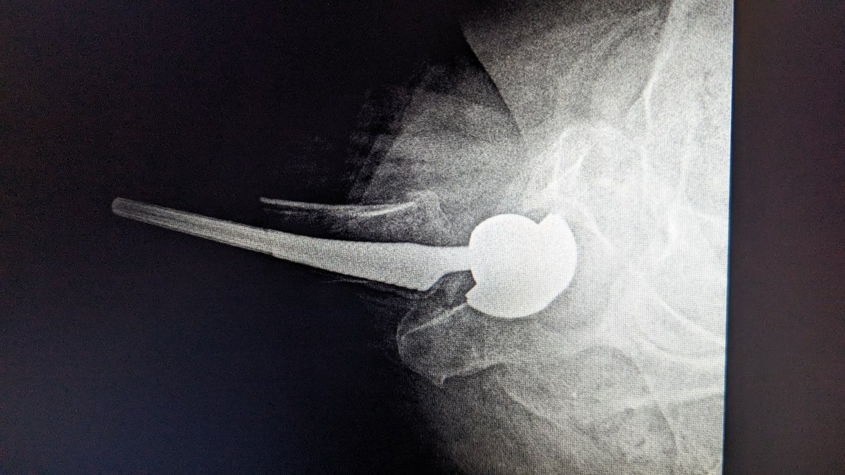Trollplasty's tweet photo. Metal on metal articulations -- a really bad idea since 1938. https://t.co/e4TTIhFHHg