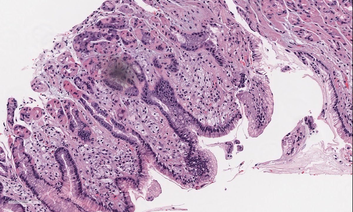 A 65-year-old male, endoscopy done for dyspepsia, gastric antrum shows yellow white nodularity.

What is your diagnosis? Which immunohistochemical studies would help to confirm your diagnosis?

Full case at: ipa-na.org/COM/09-2023