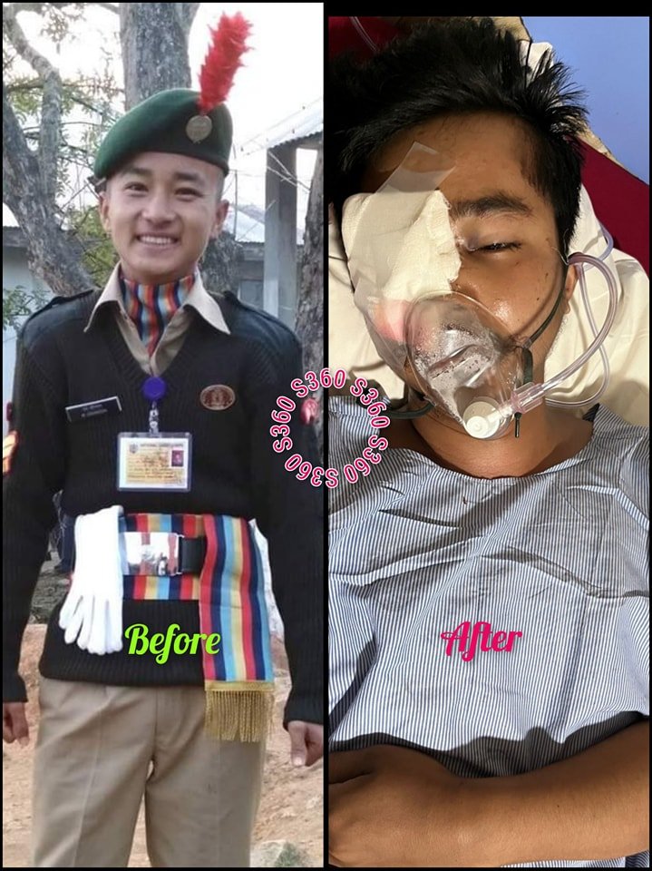 nareshchandra_1's tweet image. This is Johnson Mayanglambam, a Manipuri student seriously injured in recent street protest. 
See the dress - a proud Indian
And see now - should this be fate of a proud Indian? 

Is it a crime to be born Meitei?? Meitei have no right to protest? 
@narendramodi @AmitShah 
This is