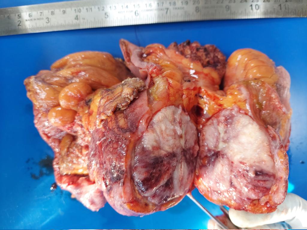 padmapathology1's tweet photo. Ileal mass
#PathTwitter #PathX
#grossognosis
#macropath
#MacroMicroCorrelation #pathresidents
#gipath
Diagnosis?? https://t.co/hdidXPYGV9