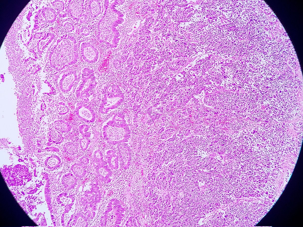 padmapathology1's tweet photo. Ileal mass
#PathTwitter #PathX
#grossognosis
#macropath
#MacroMicroCorrelation #pathresidents
#gipath
Diagnosis?? https://t.co/hdidXPYGV9