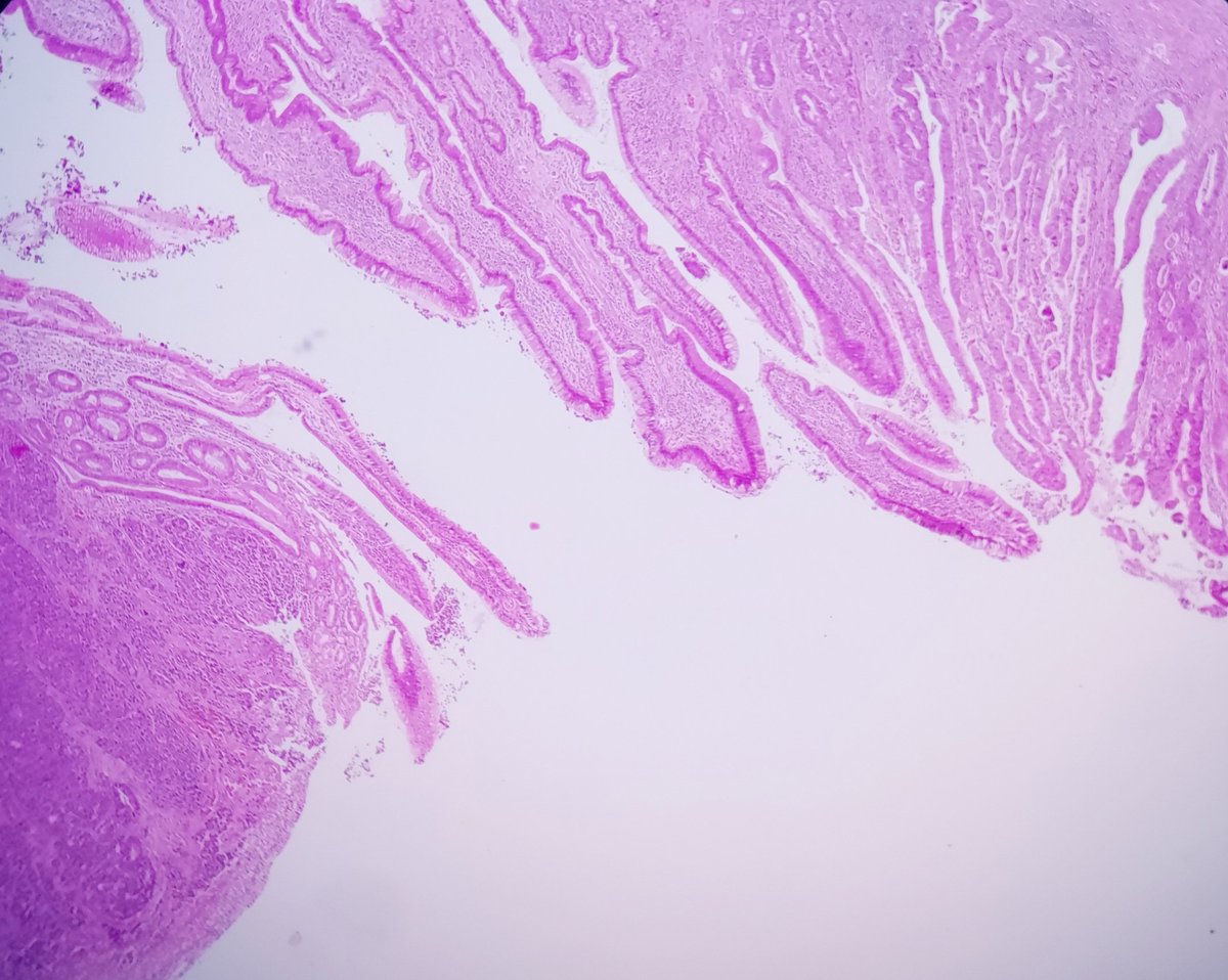 padmapathology1's tweet photo. Ileal mass
#PathTwitter #PathX
#grossognosis
#macropath
#MacroMicroCorrelation #pathresidents
#gipath
Diagnosis?? https://t.co/hdidXPYGV9