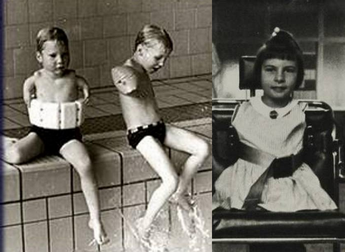 mariobianchi18's tweet photo. Il #1ottobre 1957 il #talidomide è commercializzato per la prima volta in Germania Ovest per le donne in gravidanza. Troppo tardi si scoprì che le molecole attraversavano la placenta compromettendo la crescita del feto. Oltre 10.000 bimbi nacquero con arti deformati o mancanti. https://t.co/6nkzmXkZRg