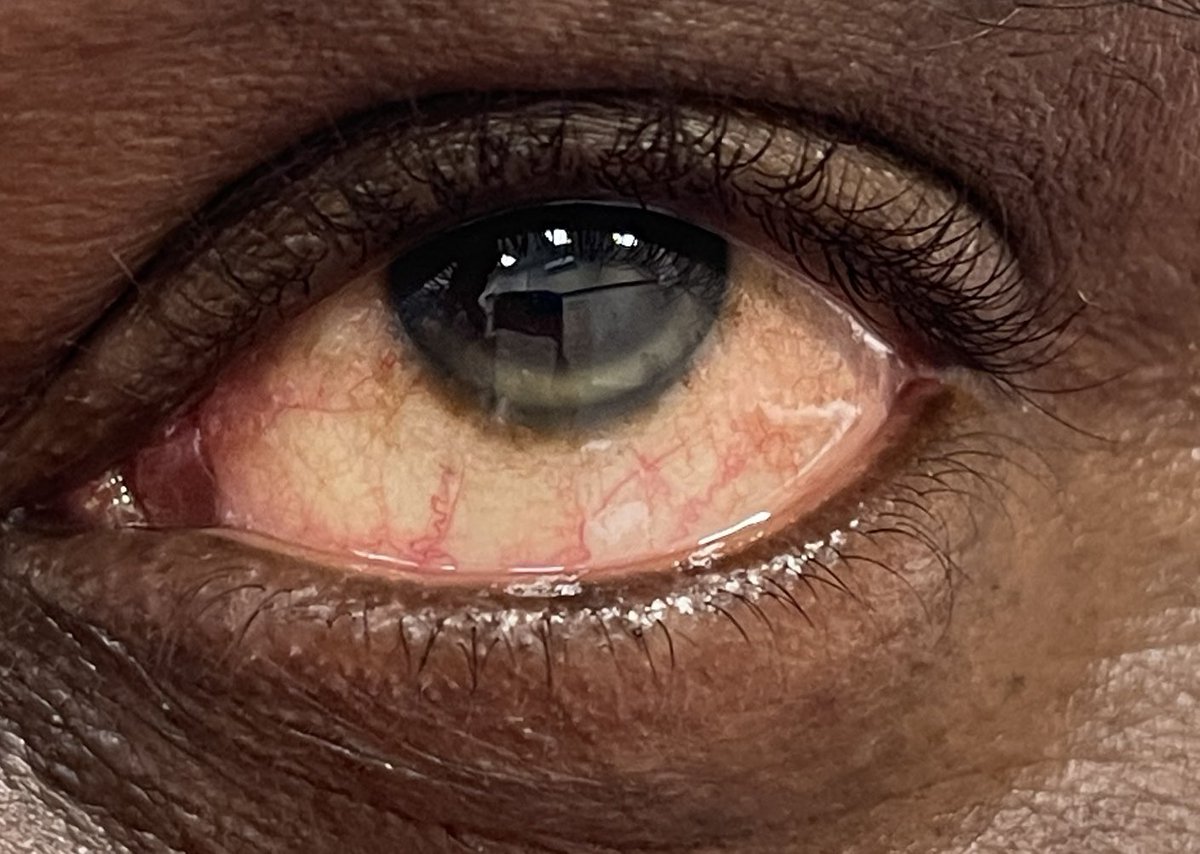 CrosbyNwaobi's tweet photo. “X” age 40.
Just popped in for a chat.
Didn’t notice the white ring on both corneas.
❌optometrist 5 years.
❌blood test ?ever
Signposted to GP:
?hyperlipidemia
?increased risk of🫀disease
Knowledge=Power
#NarrowTheGap #SaveLives
#GoToThePeople https://t.co/tZGnGeSHs6