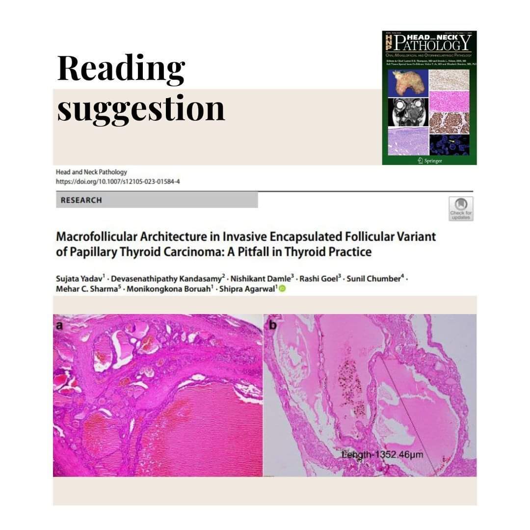 Reading suggestion: link.springer.com/article/10.100… #entpath #pathology