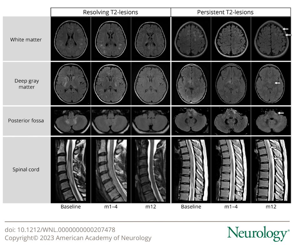This study demonstrates that T2-lesions in MOGAD usually resolve within 1 year and follow-up MRI at 6–12 months showing resolution of all or most T2-lesions can help support a #MOGAD diagnosis over competing etiologies. bit.ly/46vX0B2 #NeuroTwitter
