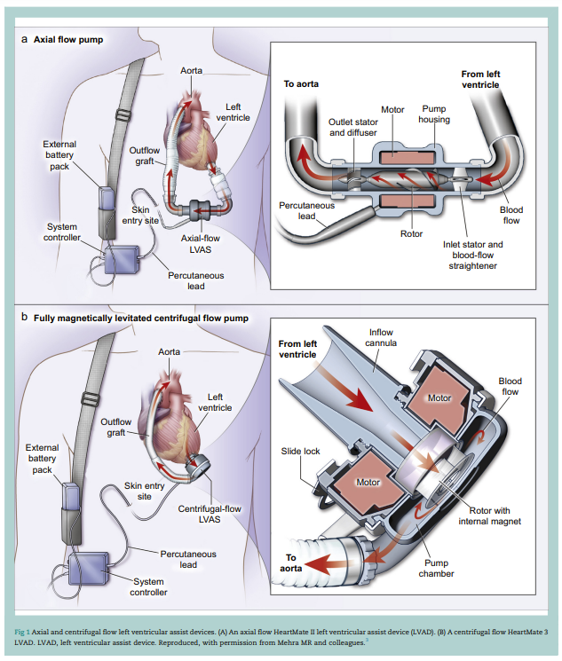 BJAJournals's tweet photo. A durable VAD may be implanted as a bridge to transplantation (UK), bridge to recovery, or as destination therapy (USA).
Understanding VADs for non-cardiac anaesthetists - a #BJAEd article by Richella-Lea Falland and Sara Allen
#VentricularAssistDevice
https://t.co/A9XTEVVuTG https://t.co/WMX9esCkaB