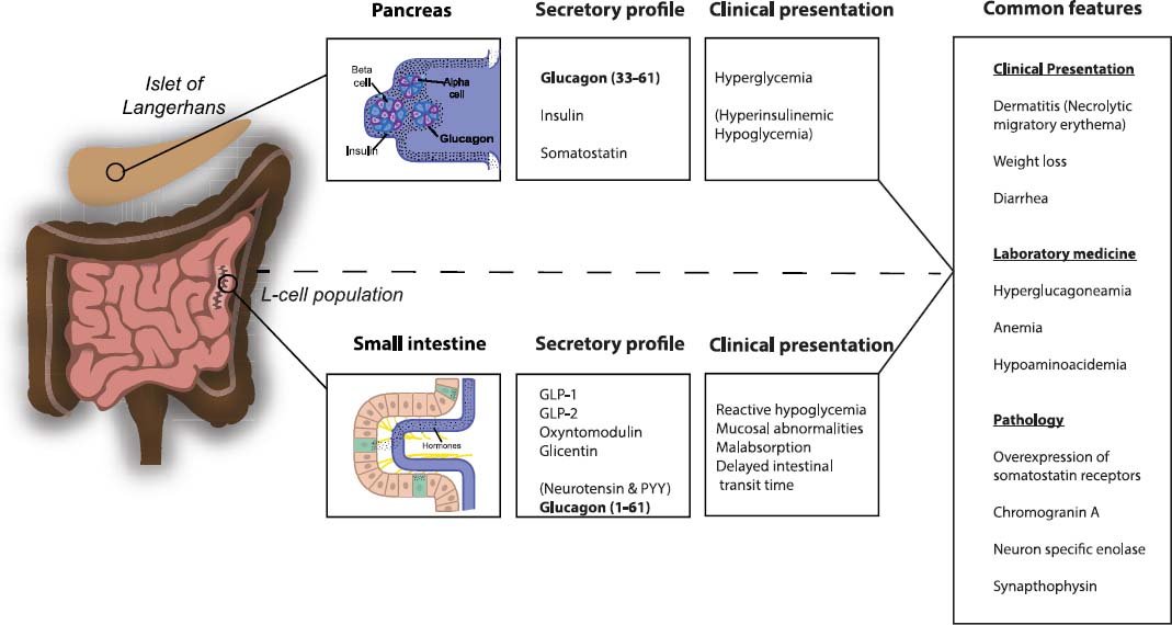 @BrownJHM Glucagonoma syndrome

👉 slow-growing pancreatic neuroendocrine tumor that secretes glucagon

(image credit: @bjbms)