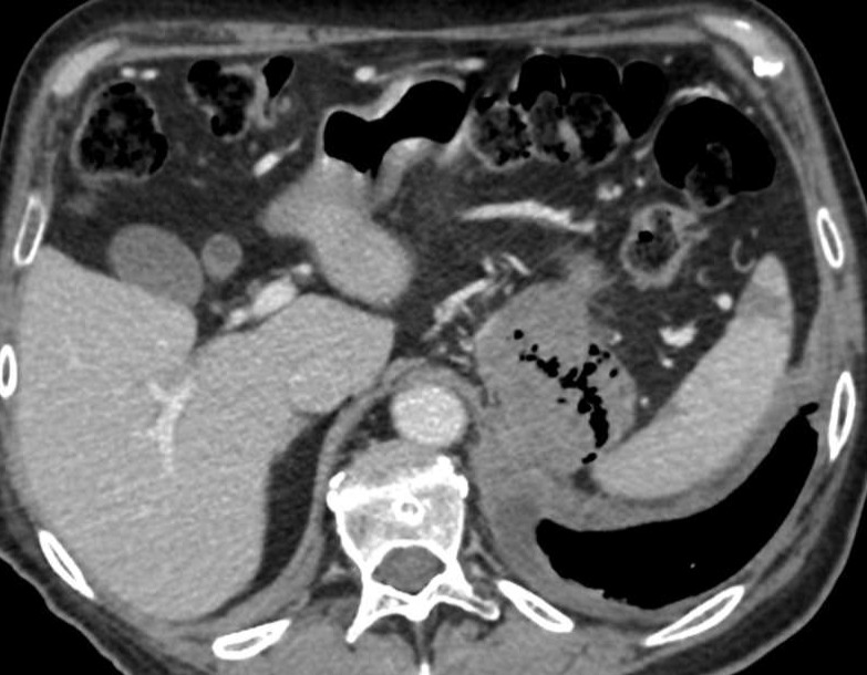 🤨 One of the weirdest adrenal mets we've ever seen... 🤔 Do you know why it has air inside? ✅ Answer tomorrow! #radiology #FOAMed #FOAMrad