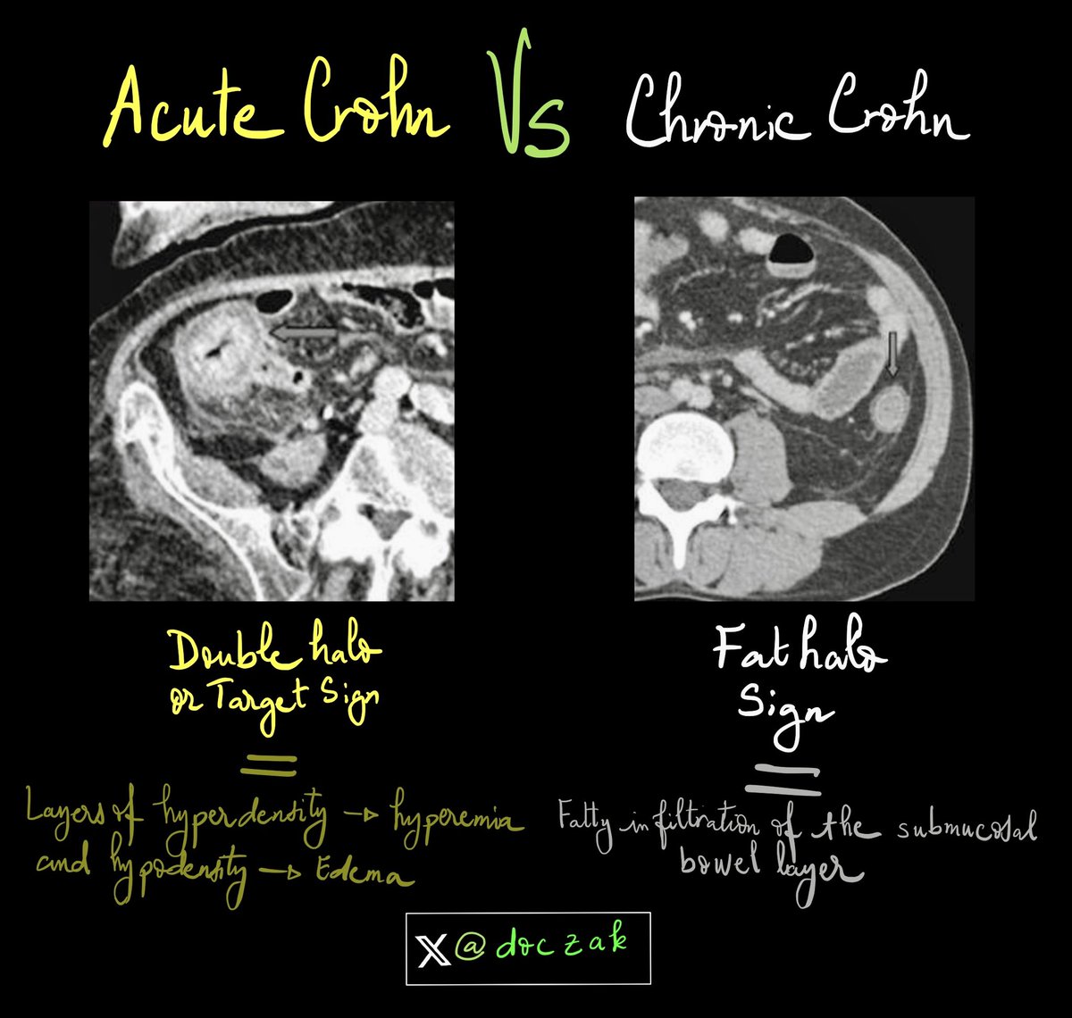 doczak's tweet photo. Acute crohn versus chronic crohn in imaging 
#foamrad
#ctscan
#crohn https://t.co/AxhnQqXzpi