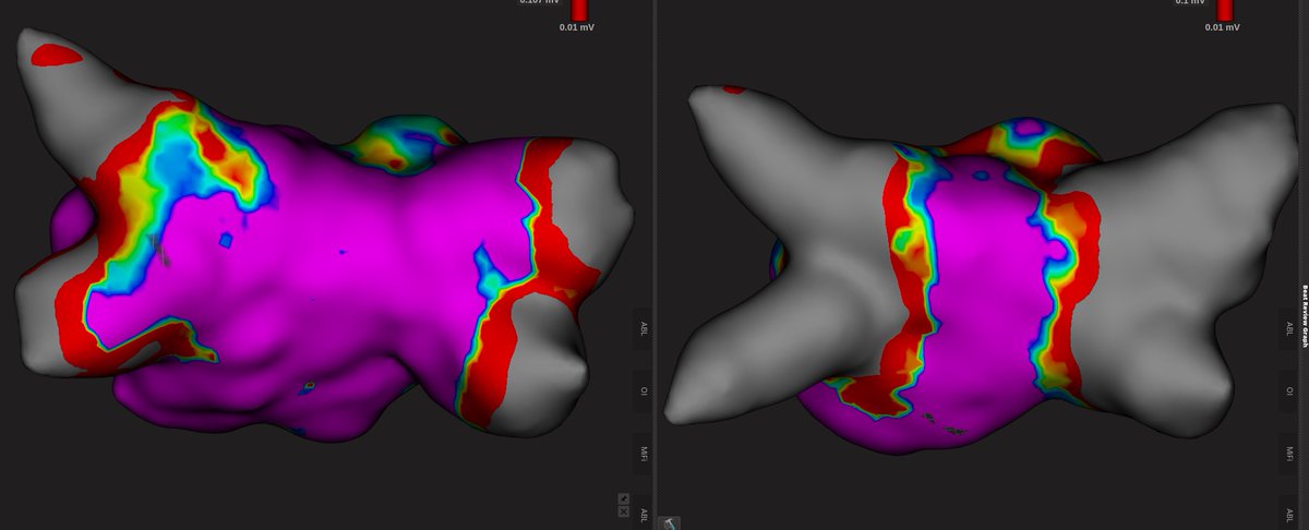 weiner_s's tweet photo. Excited to kick off the SENSATION clinical study (Treatment of symptomatic PAF with Synaptic Compliant Cryoablation) with the first 2 patients. Large / variable size balloon definitely helps in adjusting to anatomic differences. Looks like this will be a top-tier tech. #epeeps https://t.co/vTkrDvwX3v