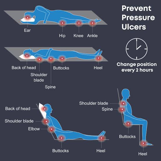 6) 🛏️ Bedsores: a painful reality. Repositioning, skincare, and special surfaces are the frontline defense. Join the fight against ulcers! 🛡️ #PressureUlcerPrevention #BedriddenCare