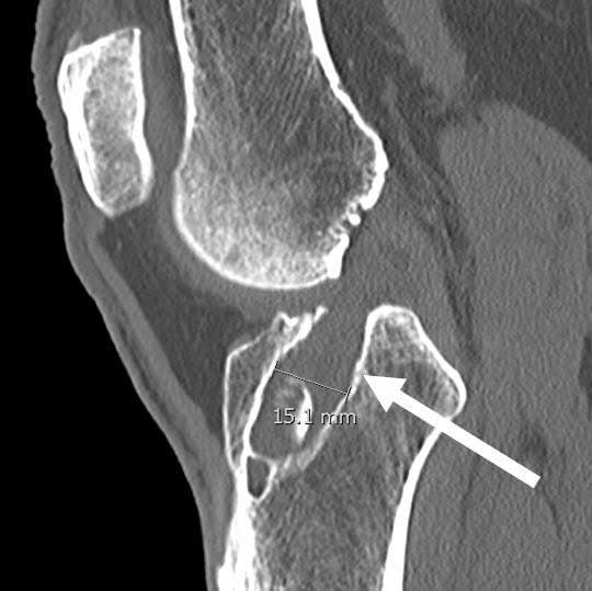 When does an ACL surgery fail?
The most common cause is a technical error in the 1st surgery.  The two most common technical errors are placing the ACL reconstruction graft on the femur too anterior or placing the tibial tunnel too posterior. medilink.us/6lh8 #orthotwitter