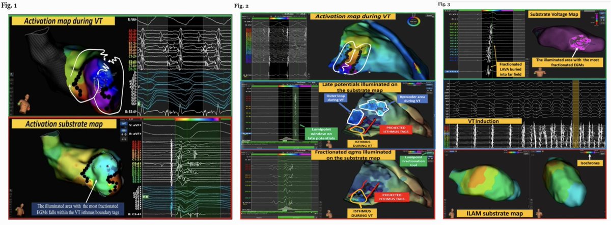 🚨New #FreeRead in <a href="/JICE_EP/">JICE</a>

Annotation-Independent Algorithm based on EGM Characteristics to Guide Identification of VT Isthmuses in Pts w/ Structural Heart Disease

by <a href="/francescosoli19/">francesco solimene</a> <a href="/g_speziale/">Giuseppe Speziale</a> V Schillaci G Stabile E Mura &amp; <a href="/bayiron123/">Ignacio García-Bolao</a>

📖🧐rdcu.be/dntPl

#EPeeps