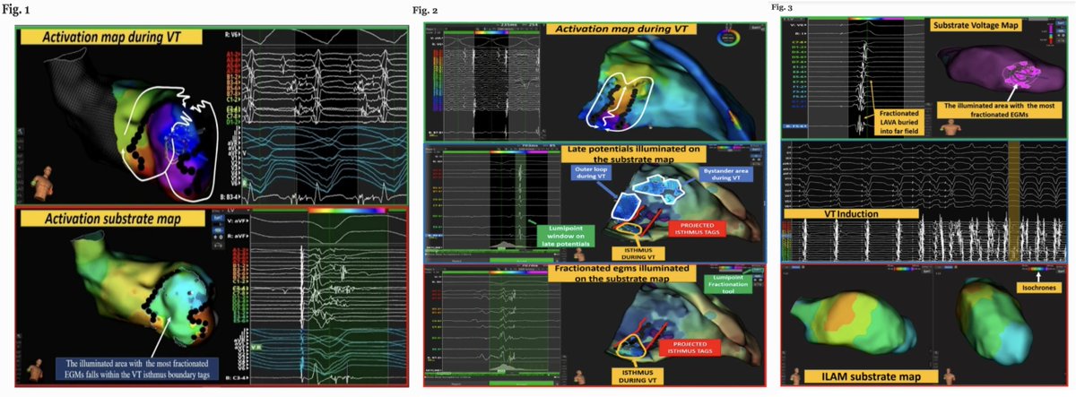 🚨New #FreeRead in @JICE_EP Annotation-Independent Algorithm based on EGM Characteristics to Guide Identification of VT Isthmuses in Pts w/ Structural Heart Disease by @francescosoli19 @g_speziale V Schillaci G Stabile E Mura & @bayiron123 📖🧐rdcu.be/dntPl #EPeeps