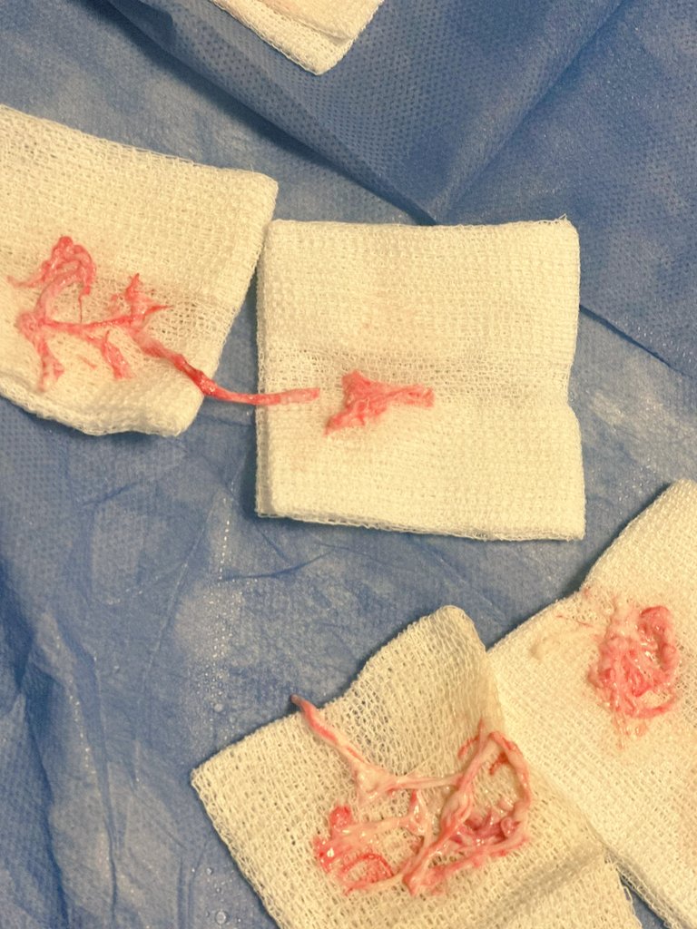 Gustavo Plotnikow 🇦🇷 (@gaplotnikow) on Twitter photo Chyloptysis is an uncommon medical condition where chyle accumulates in the sputum. The sputum is of a milky-white consistency, which may help in early diagnosis. Chyloptysis may lead to the formation of #BronchialCasts
By #FacuBianchini <a href="/romipratt/">Romina Pratto</a> 🤓👉🔗journal.chestnet.org/article/S0012-… Chyloptysis is an uncommon medical condition where chyle accumulates in the sputum. The sputum is of a milky-white consistency, which may help in early diagnosis. Chyloptysis may lead to the formation of #BronchialCasts
By #FacuBianchini <a href="/romipratt/">Romina Pratto</a> 🤓👉🔗journal.chestnet.org/article/S0012-…