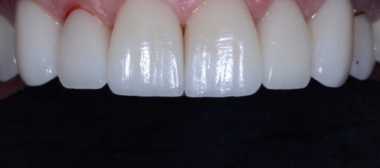 Recorded Webinar: Seating Porcelain Veneers by Lee Ann Brady DMD <a href="/LeeAnnBrady/">Lee Ann Brady</a> #dentistry bit.ly/3XbZdgF