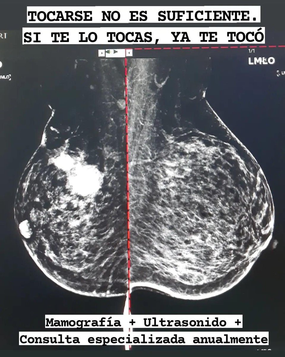Maybell_N's tweet photo. Hablando de #OctubreRosa y la campaña errónea de "tócate para que no te toque", contra el cáncer de mama:

Cuando un nódulo es palpable es pq mide al menos 1,5-2cm. En mamas grandes pueden pasar desapercibidas masas hasta de 3cm.

Lamento decir que: SI TE LO TOCAS, YA TE TOCÓ 😐 https://t.co/sGrOXt5JLh