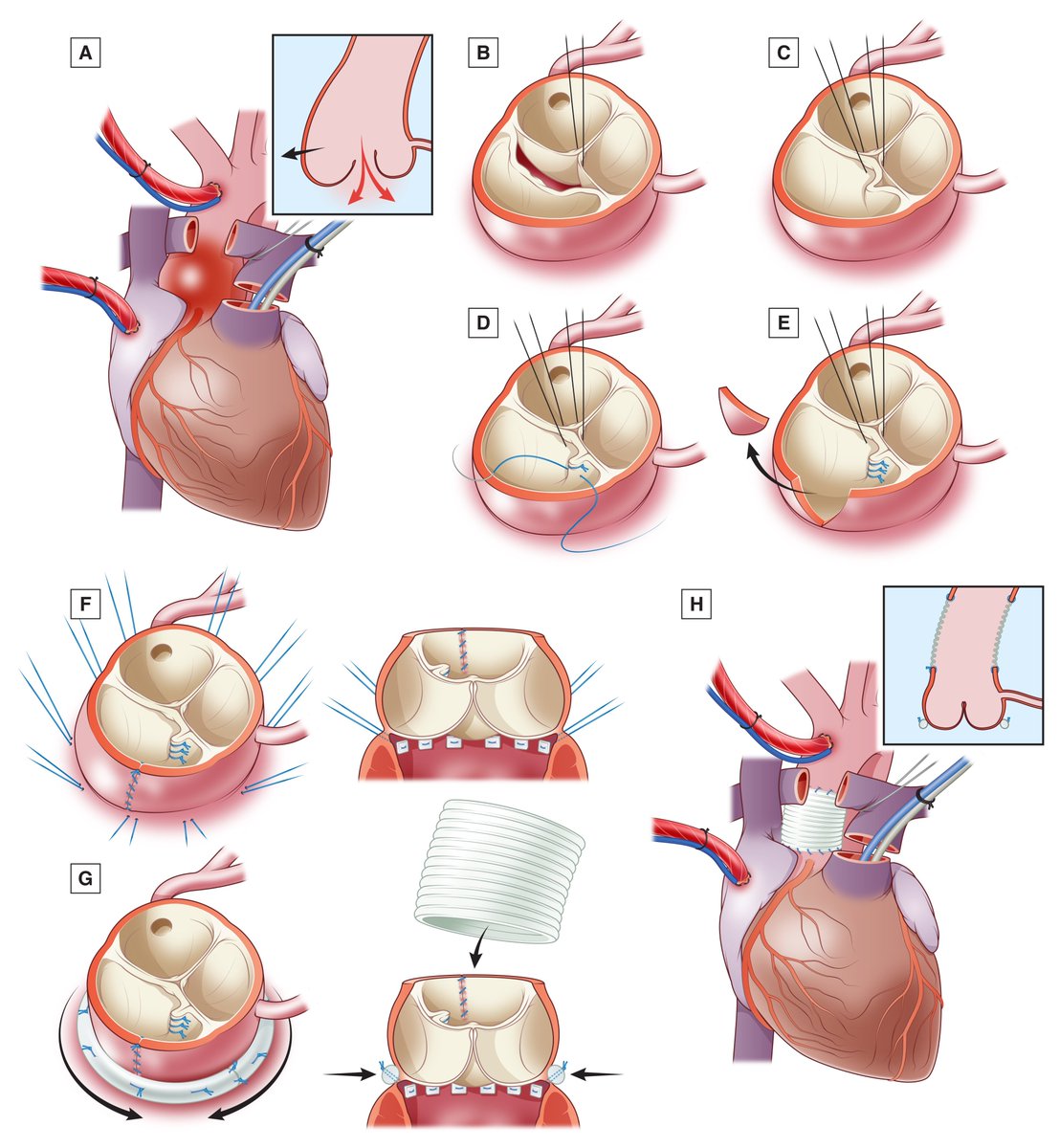 Outcomes of neo-aortic valve and root surgery late after arterial switch operation pubmed.ncbi.nlm.nih.gov/37757970/
