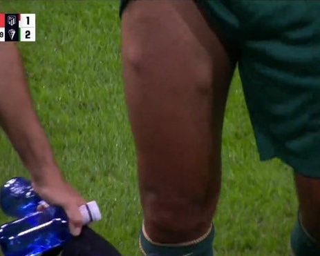 للأطباء..

ما هو تفسيرك لهذه الاصابة للاعب كرة القدم؟ 👀