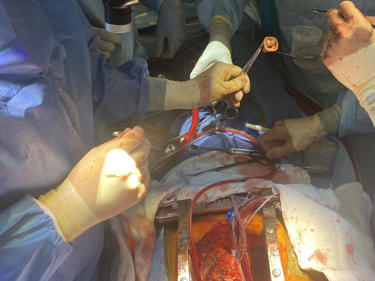 1st Thoraflex <a href="/utswheart/">UTSW Heart</a> done with my partner &amp; chair Michael Jessen. It was a 3rd time redo total arch/frozen elephant trunk &amp; redo AVR.