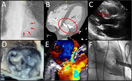 Management of valve dysfunction in patients with mitral annular calcification bit.ly/41P2fsV