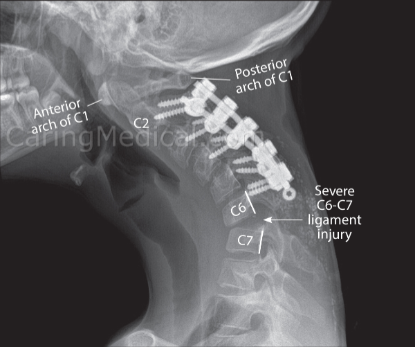 R3ALBRETT's tweet photo. BREAKING NEWS!!!

Last night following the dream match between Twisted Sisters and The Charmed Ones, Ashley Asylum taken to the local hospital, the doctor determined a severe C6-C7 ligament injury connected to her previously fused neck. 

We wish Ashley a very speedy recovery. https://t.co/GmUgvN1VUt
