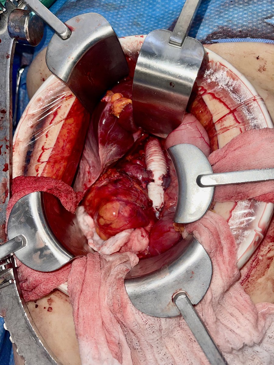 Rafael Demarchi Malgor (@rafamalgor) on Twitter photo <a href="/VarenyamVasc/">Dr Himanshu Verma</a> Agreed. Leiomyosarcoma of the Inferior Vena Cava treated with interposition PTFE graft and reimplantation of both renal veins. Proximal anastomoses just below portal vein. So far, all patent at 9-month f/u. #CavaEd(?) <a href="/XavierBerardMD/">Xavier Berard</a> <a href="/VarenyamVasc/">Dr Himanshu Verma</a> Agreed. Leiomyosarcoma of the Inferior Vena Cava treated with interposition PTFE graft and reimplantation of both renal veins. Proximal anastomoses just below portal vein. So far, all patent at 9-month f/u. #CavaEd(?) <a href="/XavierBerardMD/">Xavier Berard</a>
