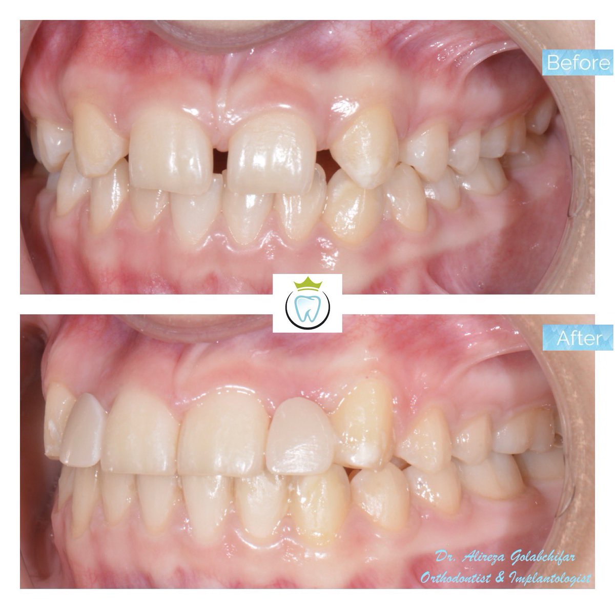 dentistry_king's tweet photo. Check out this smile Transformation!
This young patient came to us with a missing of the upper lateral incisors. With the help of braces and in-office CAD/CAM for making a Maryland bridge, we could give her a beautiful smile until the final implant placement at an older age. https://t.co/P6K8XqE2sD