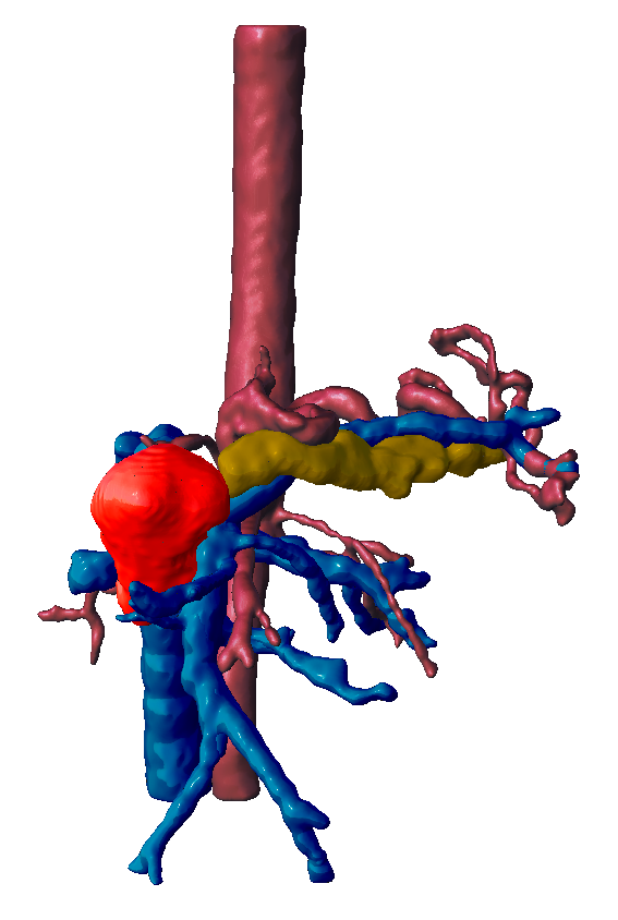 Anatomical 3D model (CMD I) for preoperative planning in case of pancreatic tumor that requiered a total duodenopancreatectomy and anastomosis to restore digestive continuity 
<a href="/3d_maranon/">FabLab 3D Hospital Marañón</a> <a href="/CHgugm/">Cirugia_HGUGM</a> <a href="/rupermac/">Rubén Pérez-Mañanes, MD PhD</a> <a href="/calvoharo_ja/">José Antonio Calvo</a> #UPAM3D #HospitalGregorioMarañon #impresion3D