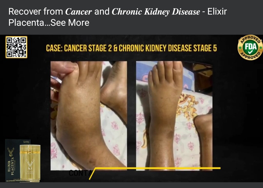 ElixirPlacenta's tweet image. Recover from Cancer Stage 2 &amp;amp; Chronic Kidney Disease.

Click to watch: tinyurl.com/2p9a2fcx

#elixirplacenta #kidney #cancer