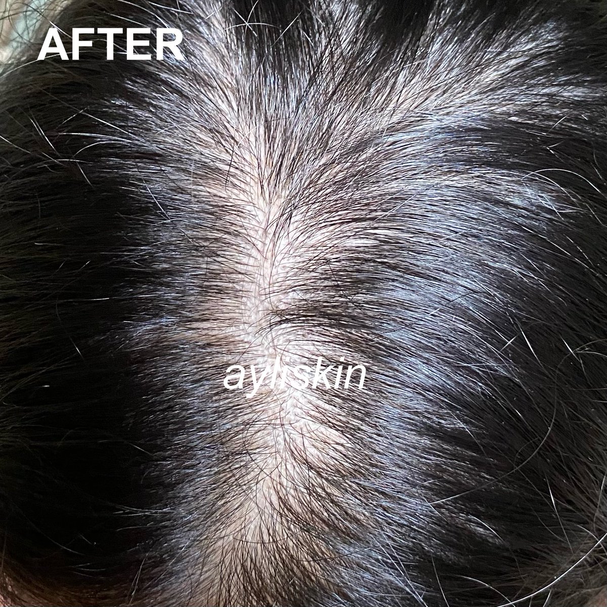ayliskin's tweet photo. apa itu rambut pitak? ga dulu deh.

hidup lagi stress gini malah nemu hair serum buat numbuhin rambut. 

#HaiRescue buat rambutku yg pitak karna rontok ternyata lumayan ngaruh🙏🏻

#racuninhaircare https://t.co/zwFQTmPS07