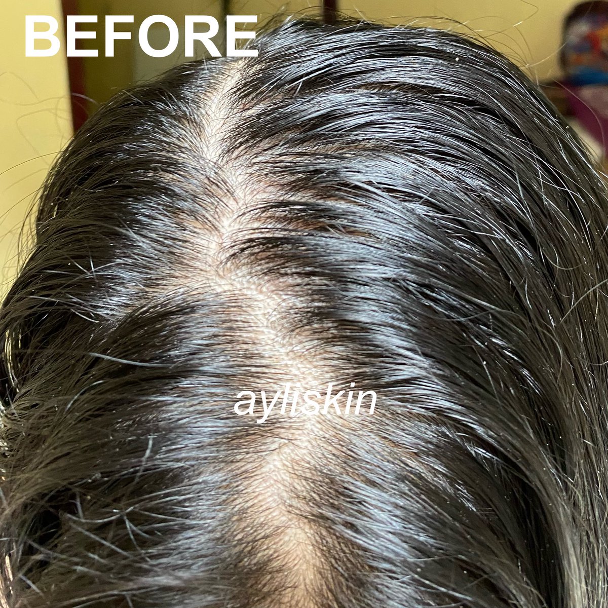 ayliskin's tweet photo. apa itu rambut pitak? ga dulu deh.

hidup lagi stress gini malah nemu hair serum buat numbuhin rambut. 

#HaiRescue buat rambutku yg pitak karna rontok ternyata lumayan ngaruh🙏🏻

#racuninhaircare https://t.co/zwFQTmPS07